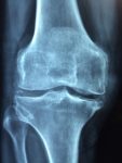 knee pain, osteoarthritis, knee arthritis, arthritis digest magazine