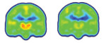 Images created by averaging PET scan data from chronic pain patients (left) and healthy controls (right) reveals higher levels of inflammation-associated translocator protein (orange/red) in the thalamus and other brain regions of chronic pain patients