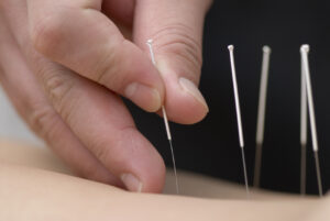 acupuncture fibromyalgia pain arthritis digest
