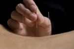 acupuncture, arthritis, osteorthritis, complementary therapy