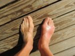 gout treatment, gout medication, gout information, gout arthritis, gout support